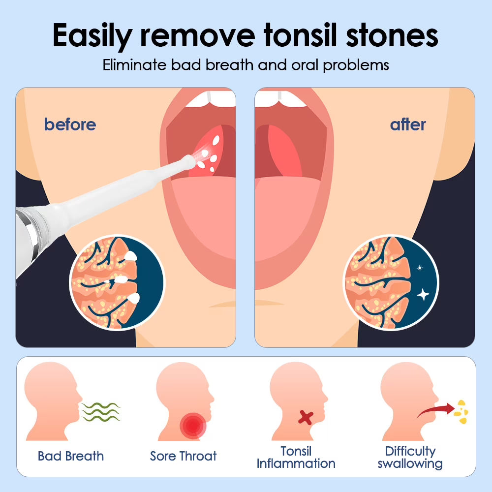 Tonsil Stone Remover, 3 Modes Adjustable Tonsil Stone Vacuum with LED Light Tonsil Stone Water Flosser for Men Women BearCris
