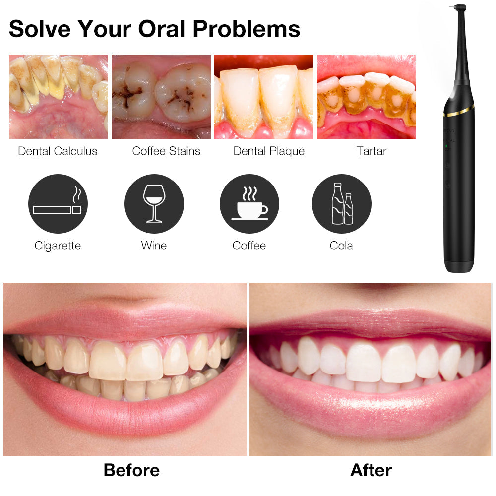 Electric Dental Calculus Remover, Ultrasonic Portable Teeth Cleaner, Tartar Plaque Stain Remover for Teeth Cleaning Tools Kit for Adult Hwallkare