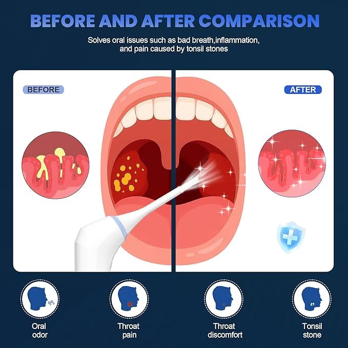 Electronic Tonsil Stone Remover Vacuum,Cordless Tonsil Stone Removal Kit Tool with 75KPA Suction & LED Light,Upgraded Tonsil Cleaner,5X Magnifying Mirror,Fight Bad Breath, Mouth Cleaning Oral Care BearCris